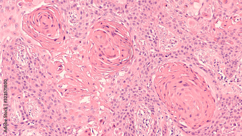 Lung Cancer Photomicrograph of a CT (CAT) scanguided needle core