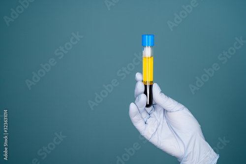 Blood plasma in vitro gloved hand holding