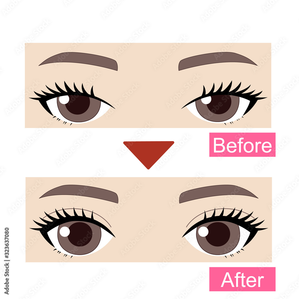 二重まぶた整形 埋没法 Stock イラスト Adobe Stock