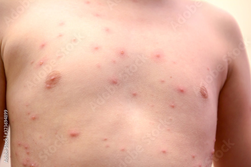 Child skin infected with chickenpox
