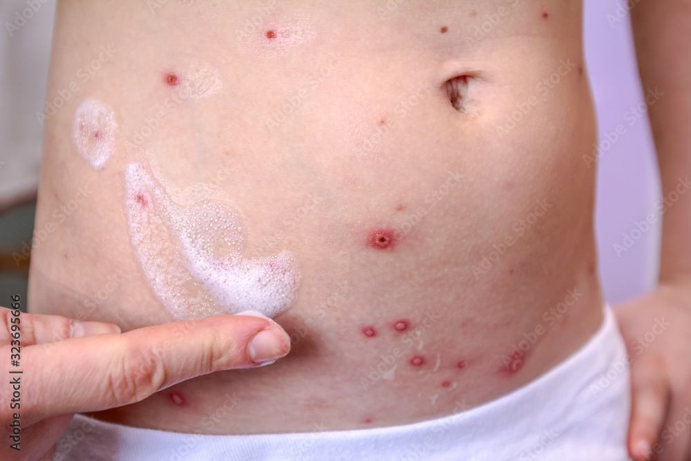 Fototapeta premium Therapy against the virus of Varicella has measles, chicken pox, rubella