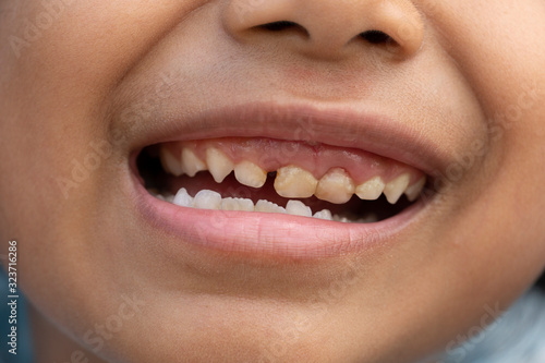 Baby teeth health for children with plaque and starting to distance away.