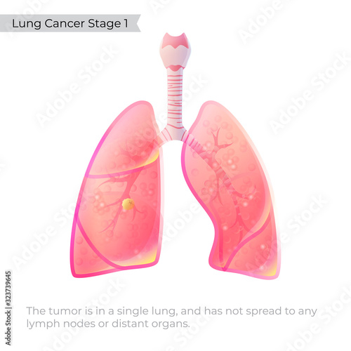 Vector illustration of lung cancer