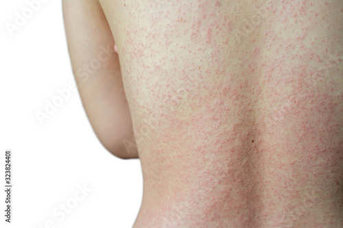 Close up Allergy rash isolated on white background. Around Back view of asian women with dermatitis problem of rash ,Allergy rash and Health problem. © tienuskin