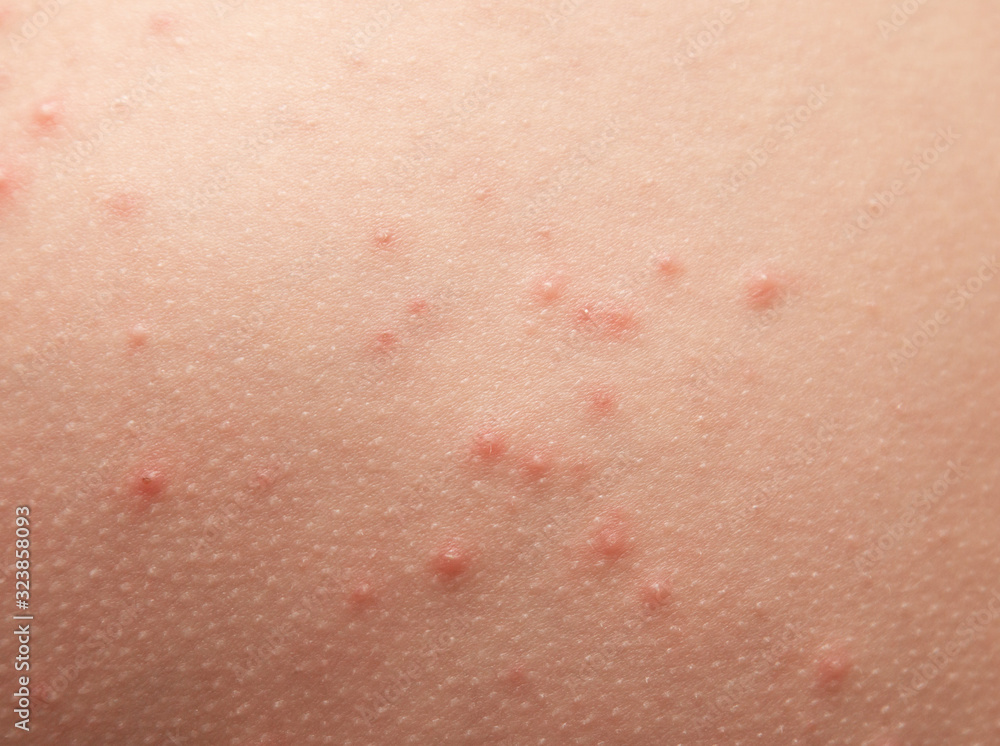 allergic rash on children's skin allergic rash on children's skin