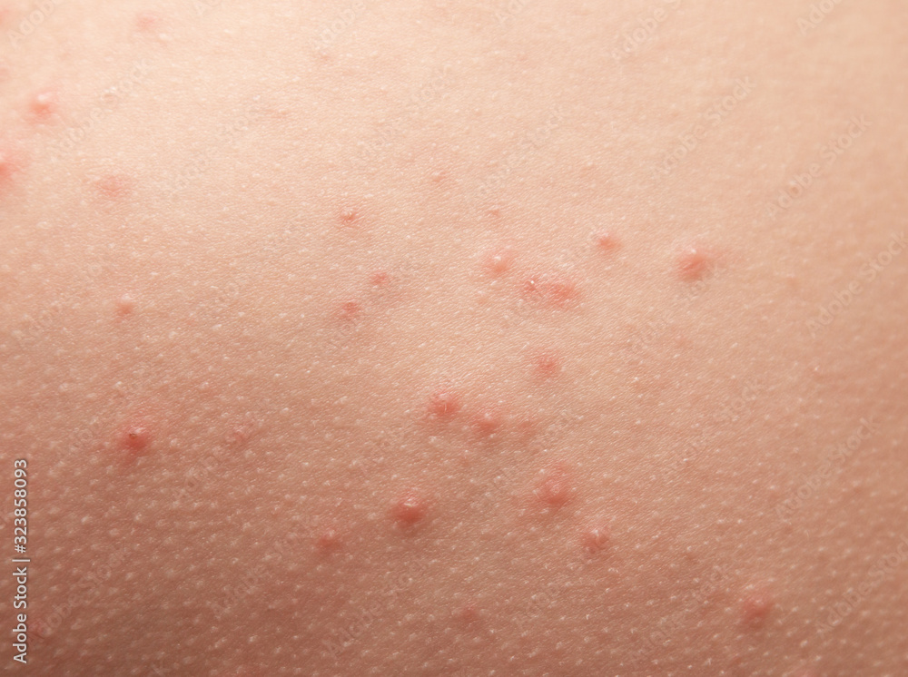 allergic rash on children's skin