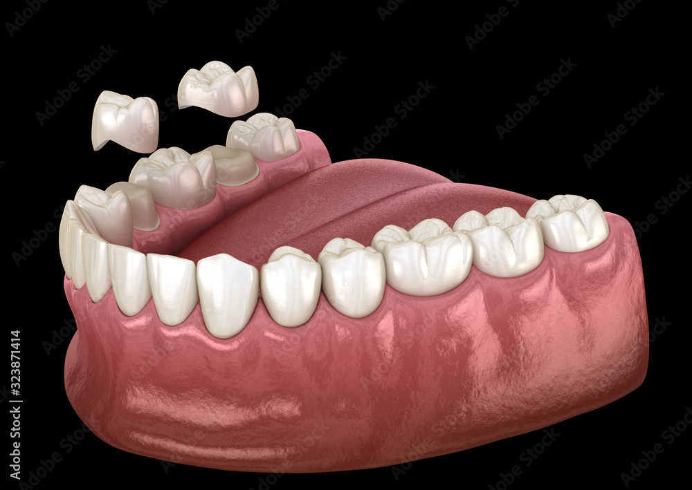Porcelain crowns placement over premolar and molar teeth. . Medically accurate 3D illustration Porcelain crowns placement over premolar and molar teeth. . Medically accurate 3D illustration
