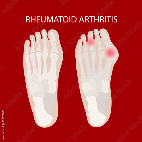 RHEUMATOID LEG Arthritis Chronic Disease Illness Medicine Education Diagram Vector Scheme Human Hand Draw Vector Illustration