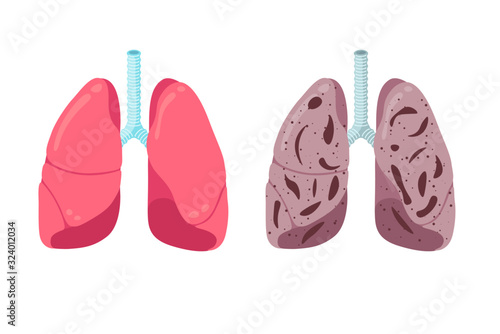 Healthy and unhealthy lungs compare concept. Human respiratory system internal organ strong and pneumonia inflammation. Healthcare respiration medical anatomy vector illustration