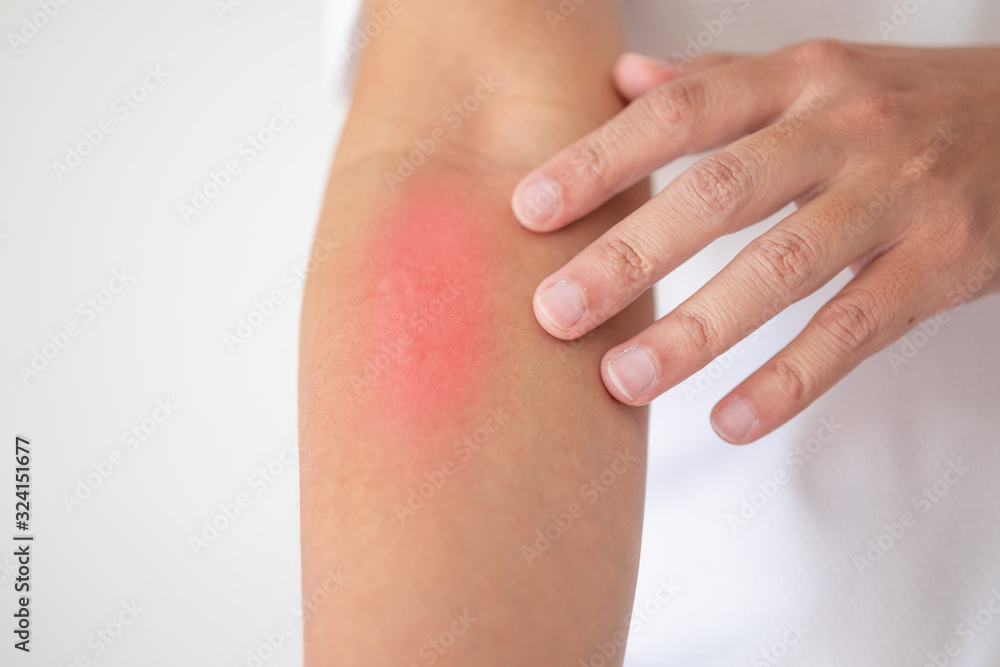 man itching and scratching on arm from itchy dry skin eczema dermatitis