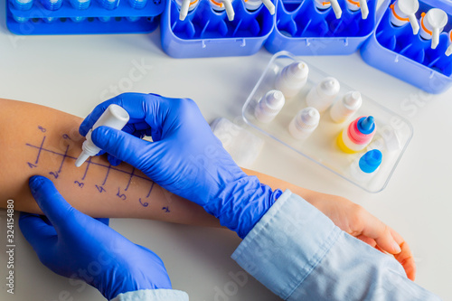 Quadro su tela Allergy skin prick tests. Allergy diagnostics.