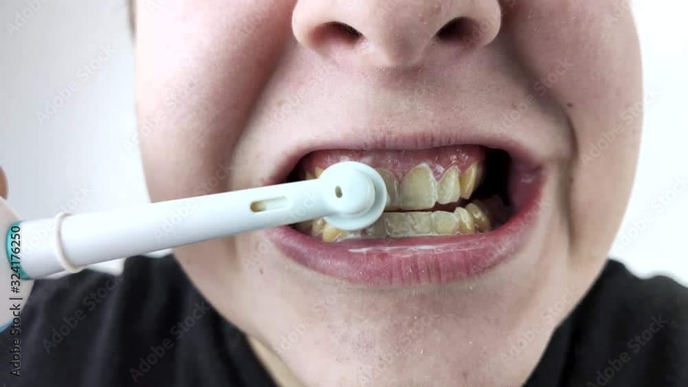 Gums bleeding and inflammation close up. Man man brushes his teeth with