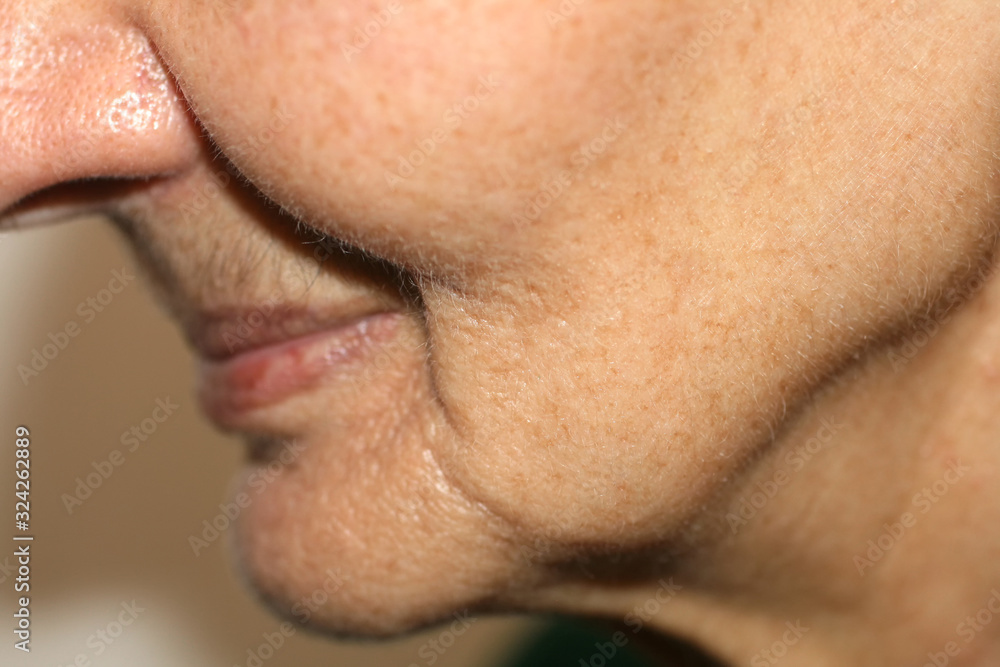 Nasolabial wrinkles. Wrinkles on the skin of the face of the neck. Flabby cheeks and neck