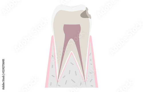 虫歯の進行、虫歯が象牙質に達する