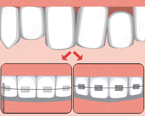 Crooked teeth on the upper jaw as a concept for bite treatment, vector stock illustration with molars with ceramic or metal braces before and after the orthodontist or dentist