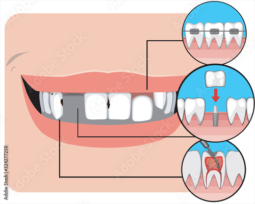 A smile with caries and crooked teeth, flat vector stock illustration with braces, molar dental implant and pulpitis as a concept of treatment by a dentist or orthodont