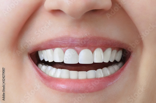 White teeth of a caucasian woman after treatment and whitening of teeth, dental crowns. Dentistry Close-up.