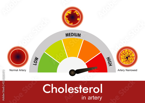 Cholesterol in artery, health risk , vector design