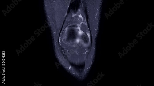 MRI knee or Magnetic resonance imaging of knee joint coronal stir view for fat suppression. photo