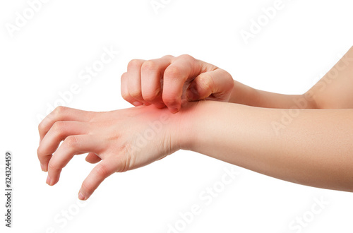 Woman has skin rash itch on arm