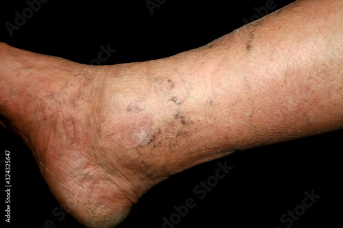 Εκτύπωση καμβά Leg. Varicose veins. Phlebeurysm. Thrombophlebitis. leg in veins.