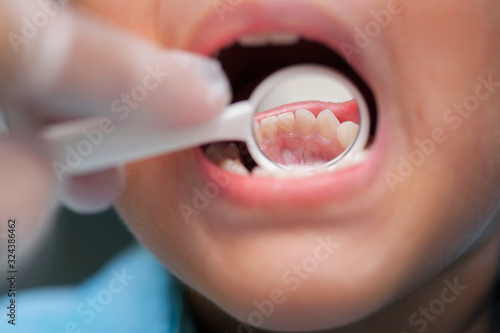 A close-up of a young boy getting a dental exam by dentist and using dental mirror to see baby teeth and gums.
