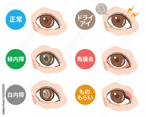 目の病気　眼病