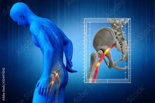 Pinched human sciatic nerve, anatomical vision. 3d illustration. photo