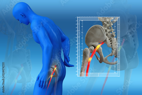 Pinched human sciatic nerve, anatomical vision. 3d illustration. photo