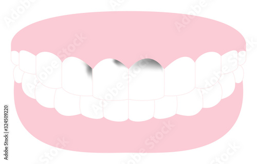 前歯に進行した虫歯のある歯のイラスト