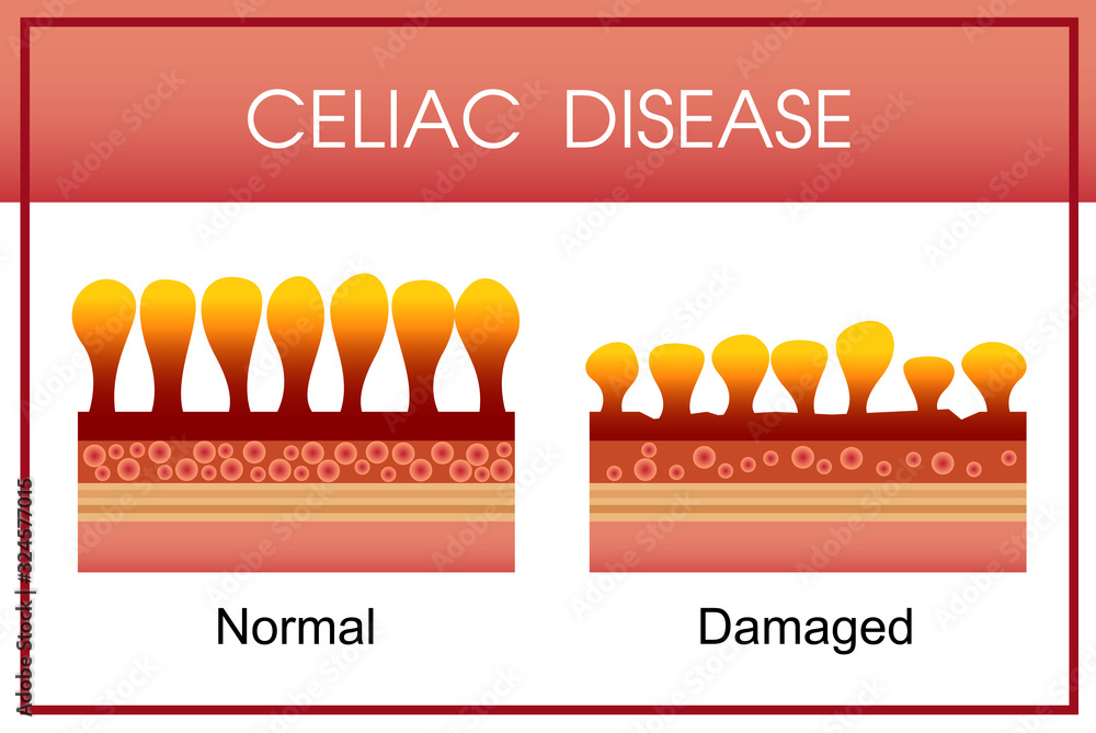 celiac disease, vector design Stock Vector | Adobe Stock