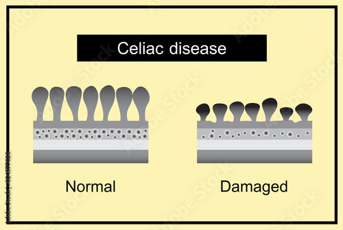 celiac disease, vector design