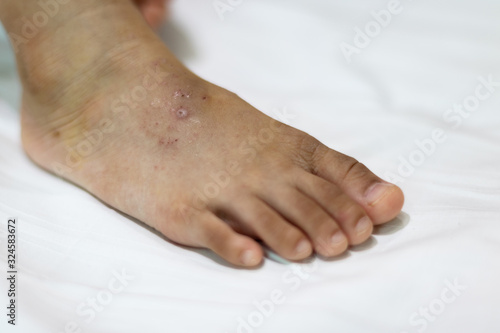 Hand Foot and Mouth Disease in Asian Children (HFMD).