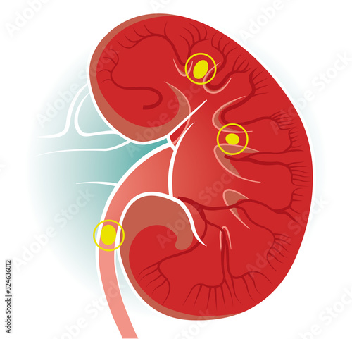 Human body view of kidneys. The kidneys are two bean-shaped organs found in vertebrates. Kidney stones