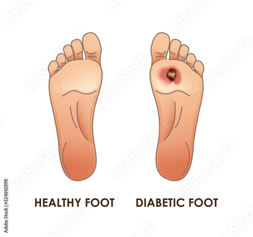 Diabetic and healthy foot. Vector illustration