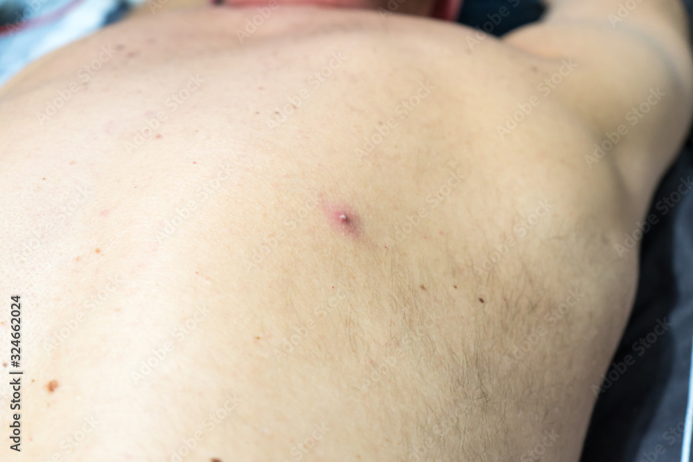 a pimple on the skin of a light-skinned man. a pimple on the skin of a light-skinned man.