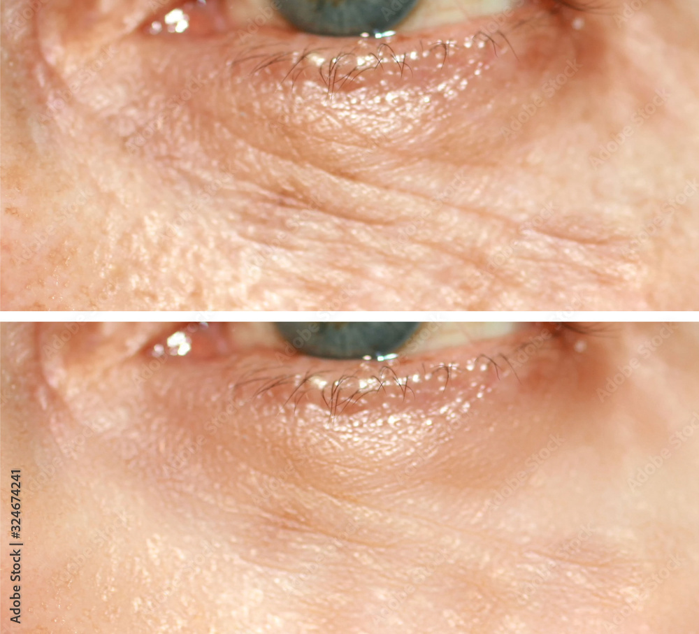 Fototapeta premium Wrinkles under the eyes. Wrinkles on the skin of the face. Flabby eyelids. Before and after treatment with a cosmetic procedure