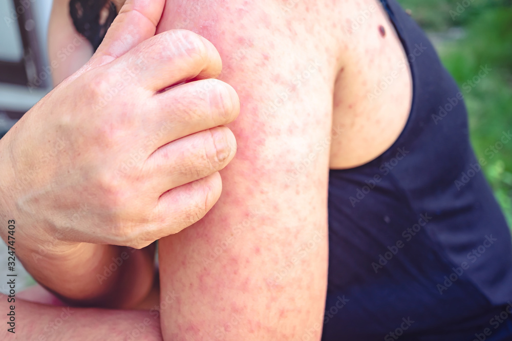 Φωτογραφία Itching of the blister on the shoulder, Close-up of a young woman scratching her shoulder with one hand due to itching, The girl scratched her shoulder because of itching blisters
