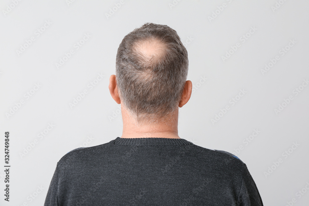 Senior man with hair loss problem on light background Senior man with hair loss problem on light background