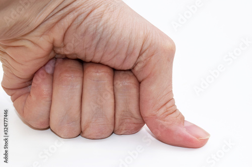 Joint hypermobility - hand with hypermobile thumb close up photo