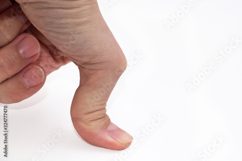 Joint hypermobility - hand with hypermobile thumb close up photo