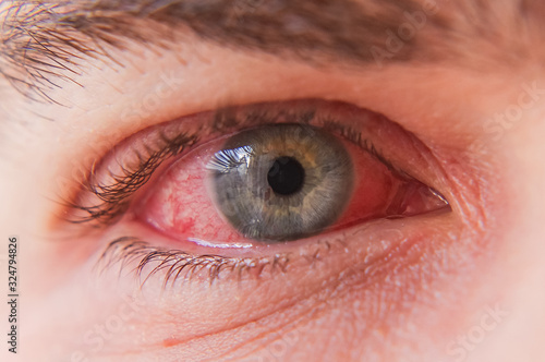 Macro closeup of  conjunctivitis infeced red eye photo