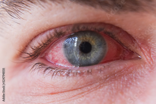 Принти на полотні Macro closeup of  conjunctivitis infeced red eye