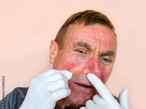 Demodecosis of the face. A man in gloves does the treatment of facial skin with medications. Prevention and treatment of skin diseases. photo