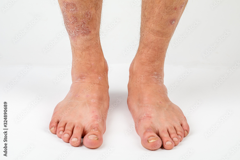 Close-up of the legs of a man suffering from chronic psoriasis on a white background. Close-up of the legs of a man suffering from chronic psoriasis on a white background.