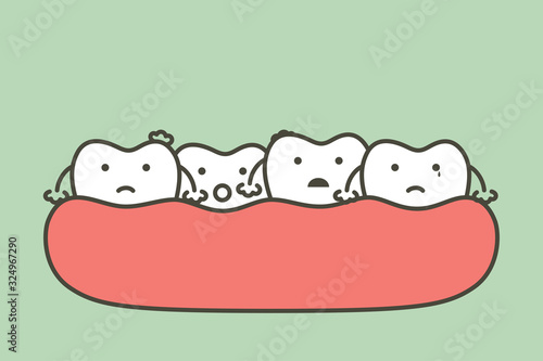 crowding teeth (malocclusion), dental problem - tooth cartoon vector flat style