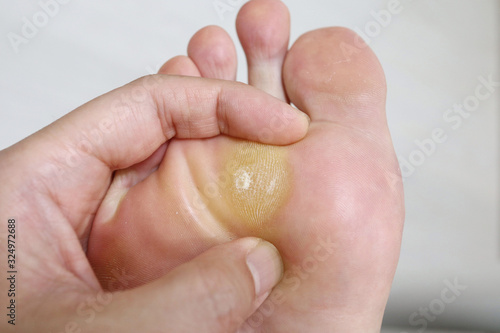 callus
