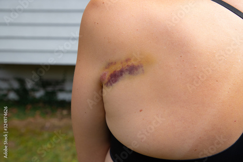 Woman with a colorful bruise on her back. 