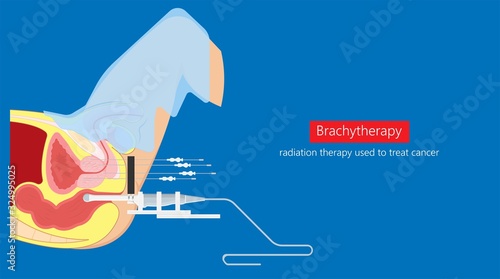 Brachytherapy procedure radioactive material medical treatment therapy