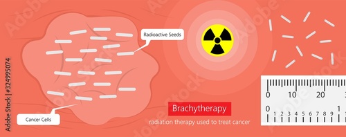 Brachytherapy procedure radioactive material medical treatment therapy